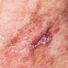 White Patch On Face Skin Cancer