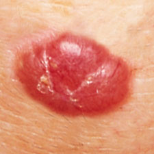 Red Patch Of Skin Under Breast