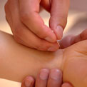 acupuncture-arthritis-treat