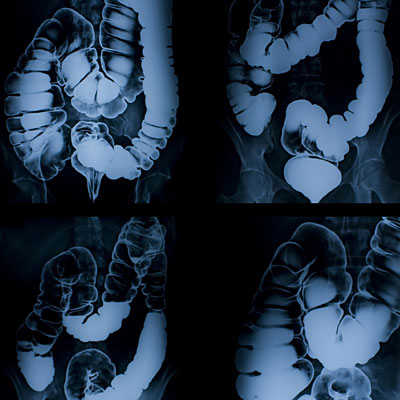 colonoscopy-test