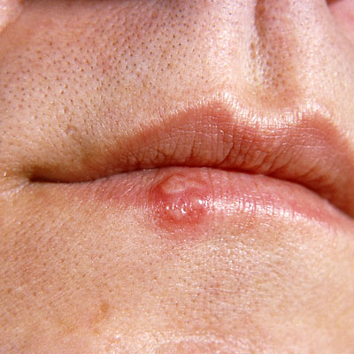 Cold Sores Herpes Genital