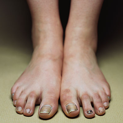 ugly-feet-nails