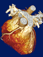 ct-heart-scan