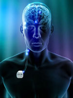 deep-brain-stimulation-parkinson