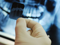 teeth-x-ray-root-canal