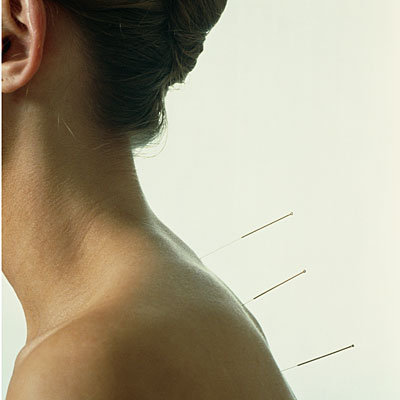 auricula acupuncture for influenza a