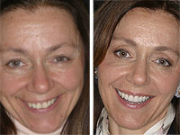 fix old dental work
