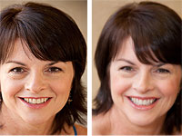 whiten stained teeth