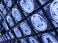 brain-injury-scan