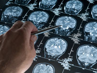 headache-diagnosis