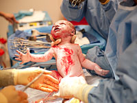 baby-delivery-surgery
