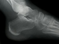bone-density-Xray