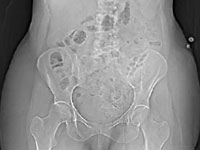 pelvic-problems