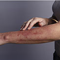 rash-on-arm