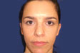 dysport-jen-after