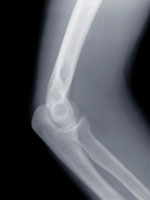 knee-xray-amanda