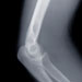 knee-xray-amanda