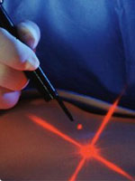 laser-acupuncture