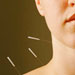 acupuncture-woman-cancer