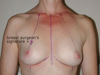 rebuild your breast