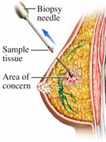 Breast Cancer Biopsy