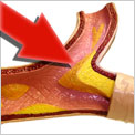 clog-artery-200