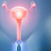 polycystic-ovaries-uteris