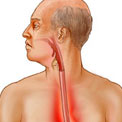 acid-reflux
