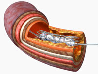 stent catheter