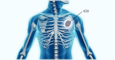 defibrillator-size-diagram
