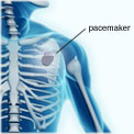 pacemaker-size-diagram