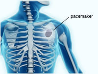 heart monitor implant side effects