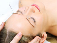 acupuncture-closeup