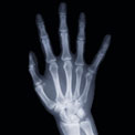 osteo-arthritis-hand