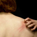 woman-scratching-rash