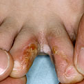 athletes-foot