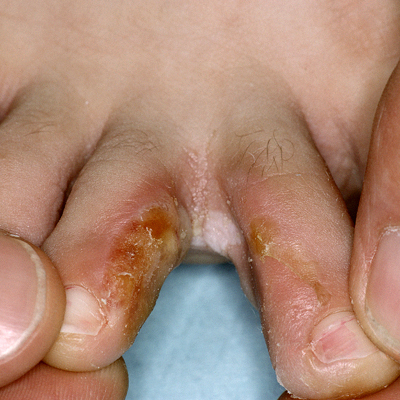 Athletes Foot Disease