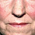 butterfly-rash