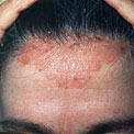 dandruff