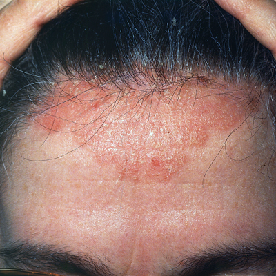 rash scalp