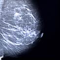 dense-breast-mamo