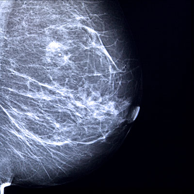 dense-breast-mamo