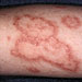 pinpoint red dots on skin lupus