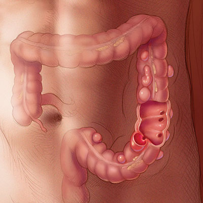 diverticulitis