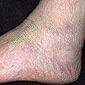 dry-skin