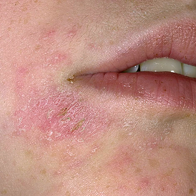 Eczema Rash