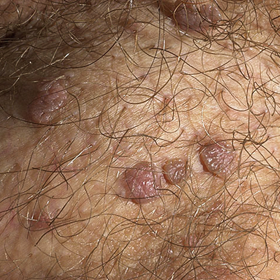 Genital Warts (HPV) Picture Image on MedicineNet.com