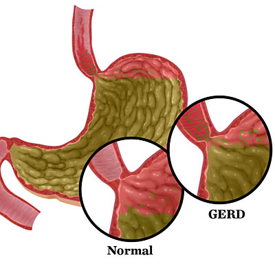 gerd-illustration