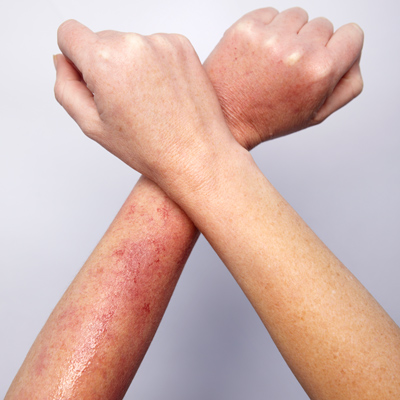 Upper arm rash - RightDiagnosis.com