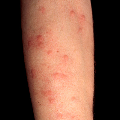 Hives (Urticaria) | Causes, Symptoms & Treatment | ACAAI ...